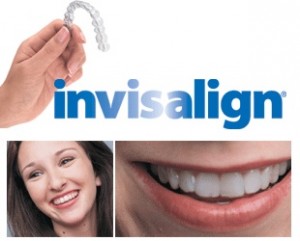 Invisalign Orlando FL