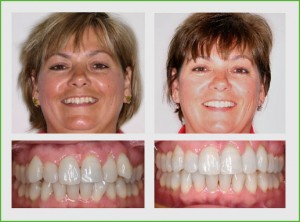 In only seventeen months wearing Invisalign braces this patient’s smile was transformed 