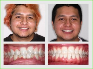 In twenty two months this patient's crowded upper and lower teeth were corrected with Invisalign treatment