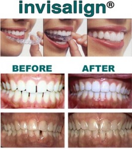 Invisalign Before & After Photos