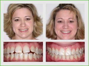 Invisalign before and after in twenty months of Invisalign treatment